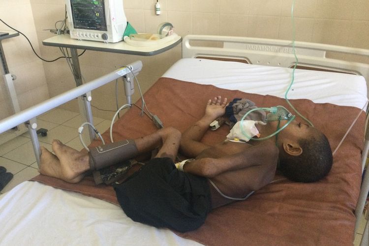 Ais Utasad (4), bocah yang diduga mengalami ‘tumor’ di bagian lehernya, saat dirawat di RS Dian Harapan, Distrik Heram, Kota Jayapura, Papua, Rabu (28/2/2024), sebelum mengembuskan nafas terakhirnya (meninggal dunia).