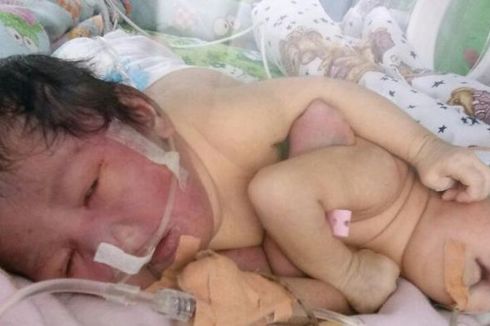 Bayi Kembar Siam yang Lahir di Toilet Akan Dioperasi Pemisahan