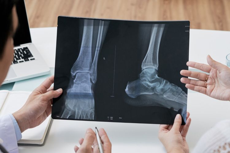 Ilustrasi kanker tulang.