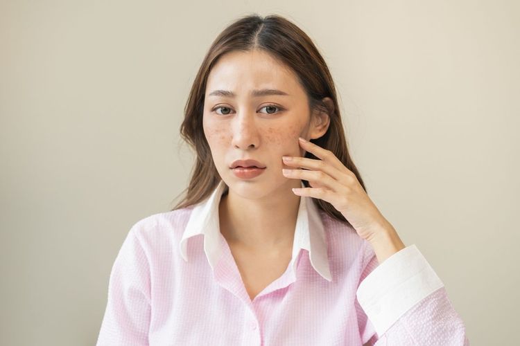 Penyebab Melasma, dari Paparan Sinar Matahari hingga Pil Kontrasepsi