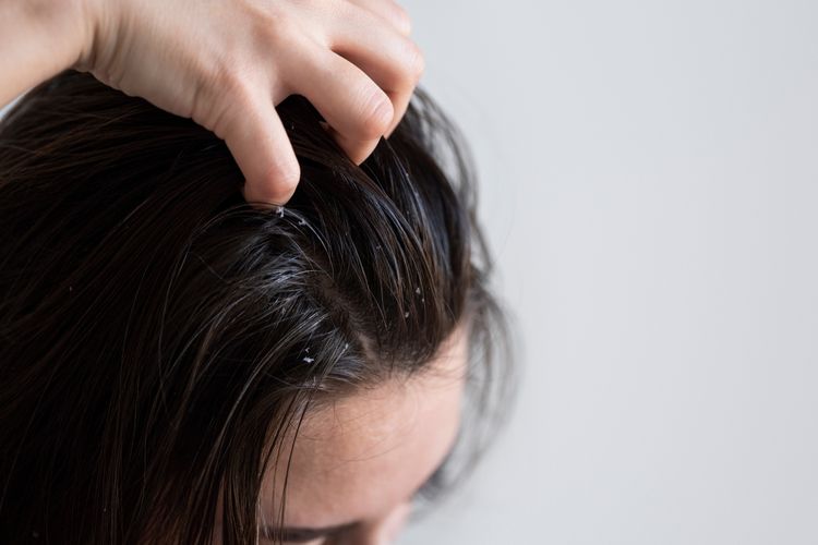 Benarkah Ketombe dan Kulit Kepala Gatal Picu Rambut Rontok?