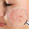 Mengenal Apa Itu Rosacea, Ciri-ciri, dan Penyebabnya