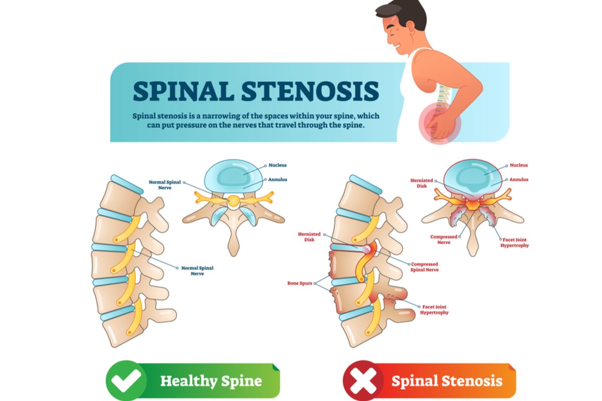 ilustrasi stenosis spinal