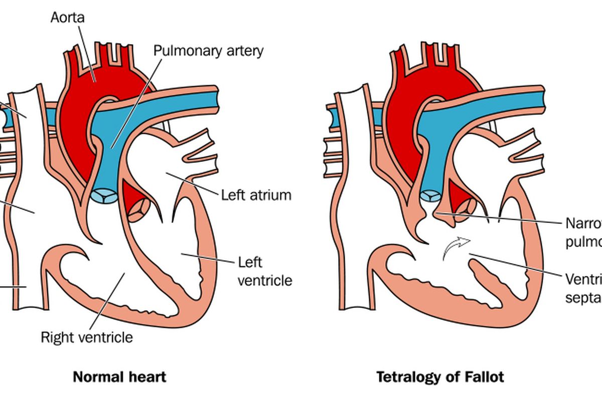 Ilustrasi Tetralogy of Fallot