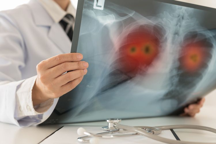 Ilustrasi CT scan pemeriksaan paru-paru. Penyakit hipertensi paru adalah penyakit langka atau jarang ditemukan, namun berisiko dialami mereka yang memiliki penyakit jantung bawaan.