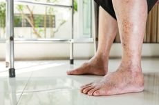 Diabetic Foot Bisa Berujung Amputasi, Dokter Ungkap Cara Mencegahnya 