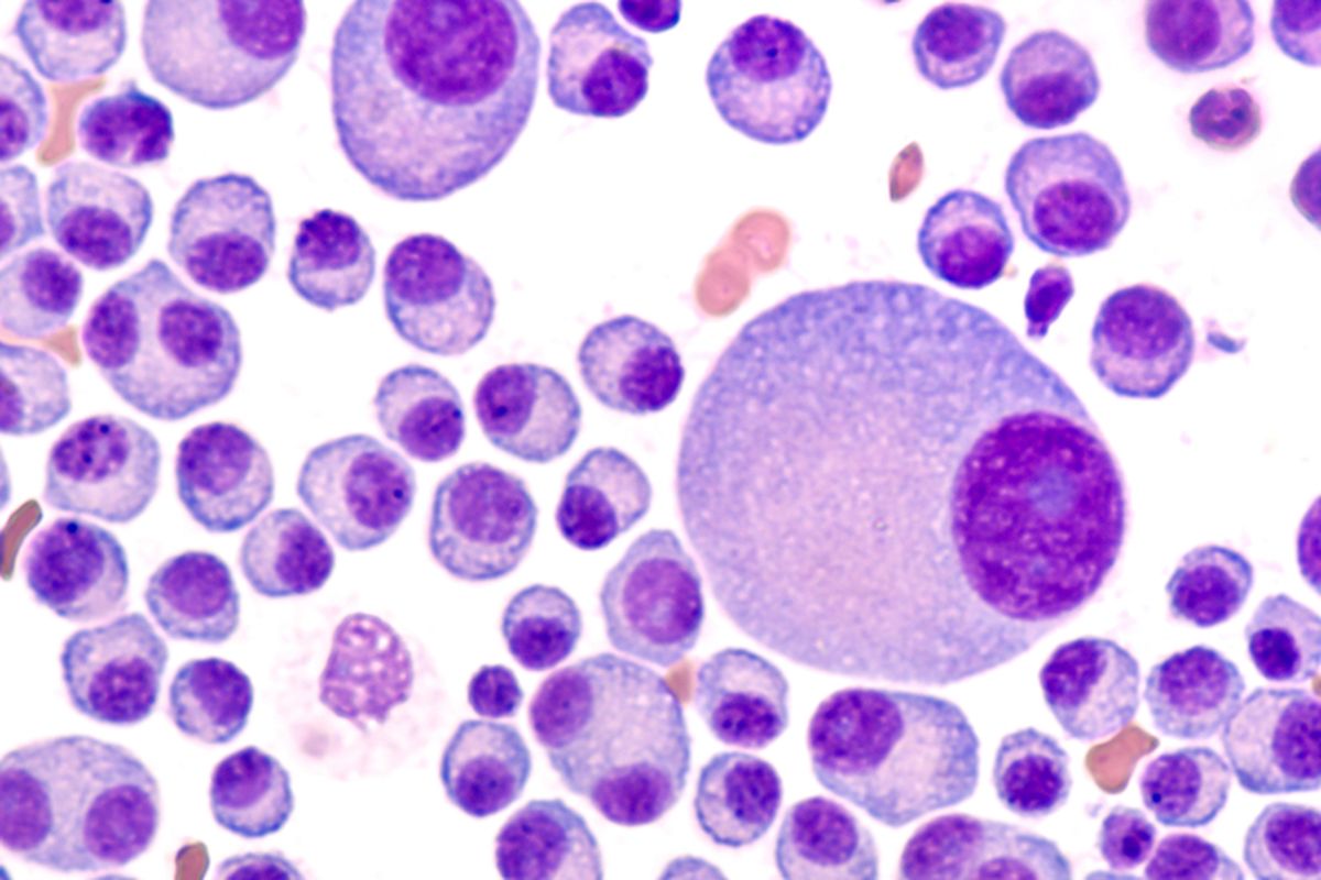 Hasil aspirasi sumsum tulang yang menunjukkan multiple myeloma. Multiple myeloma adalah jenis kanker yang menyerang sel plasma darah yang terletak di sumsum tulang.