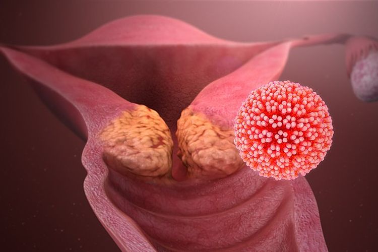 Human papillomavirus (HPV). Infeksi human papillomavirus (HPV) dapat memengaruhi berbagai bagian tubuh, termasuk alat kelamin. Infeksi ini bisa menyebabkan kanker serviks. 