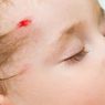 10 Gejala Hemofilia yang Perlu Diwaspadai
