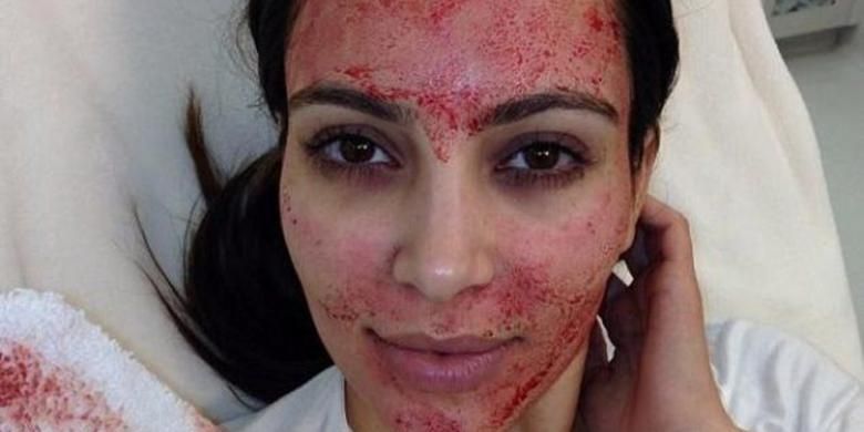 Kim Kardashian lakukan perawatan Vampire Facial
