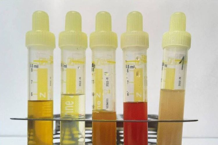 Urine Keruh Gejala Penyakit Apa? Ini 13 Daftarnya