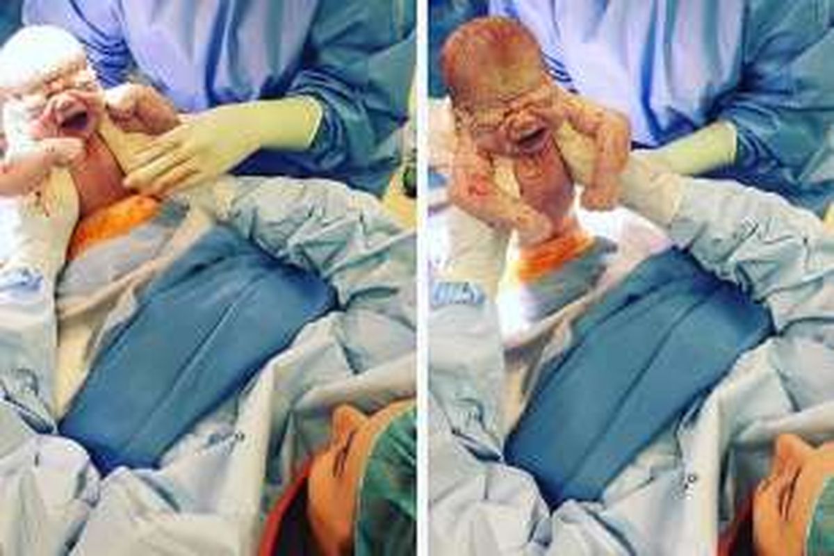 Foto Sarah Toyer mengangkat bayi dari rahimnya saat operasi caesar.
