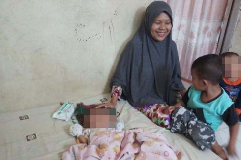 Cerita Gilang, Bayi Berwajah Dua yang Lahir di Batam