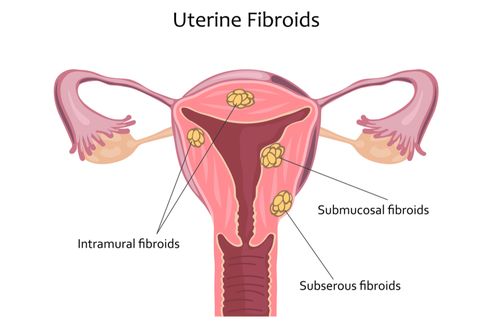 Fibroid Rahim