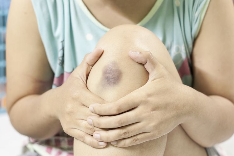 Anak Meisya Siregar Alami ITP, Ini Penyakit Langka yang Bikin Tubuh Mudah Memar