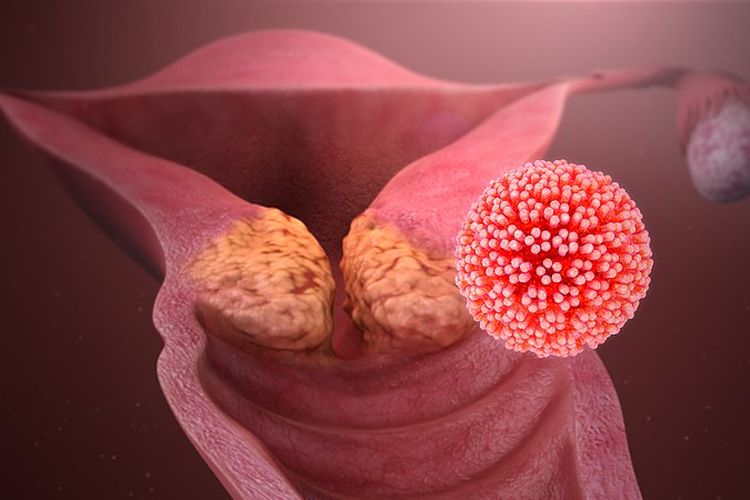 Human papillomavirus (HPV) yang menyebabkan kanker serviks, gejala HPV pada wanita.  