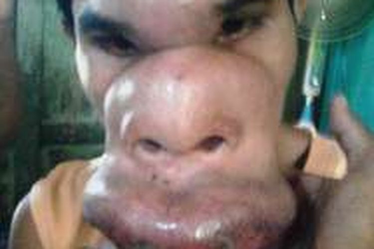 Yusuf (21) warga Dusun Rasabou, Desa Tembalae, Kecamatan Pajo, Kabupaten Dompu NTB, menderita penyakit aneh di bagian mulut.