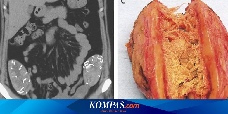 Malpraktik Bedah Sesar Kain Kasa Bersarang Di Perut Selama Enam Tahun Halaman All Kompas Com