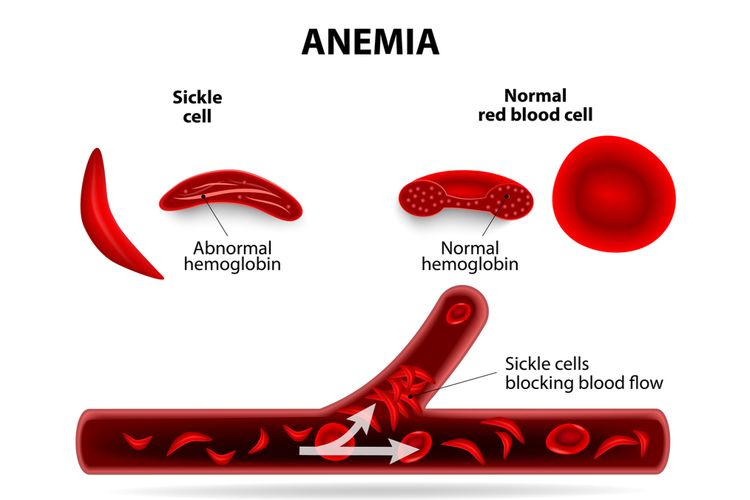 ilustrasi anemia sel sabit