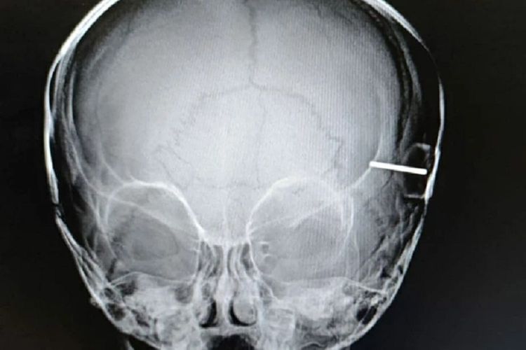 Pemeriksaan sinar X menunjukkan ada ban mobil-mobilan yang menancap di kepala bayi 10 bulan ini.