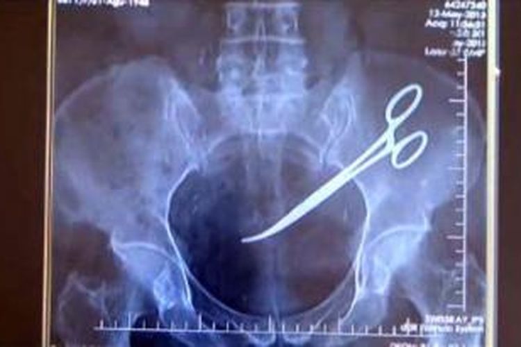Gunting operasi tertinggal di dalam perut pasien pascaoperasi terlihat melaui sinar X-Ray.