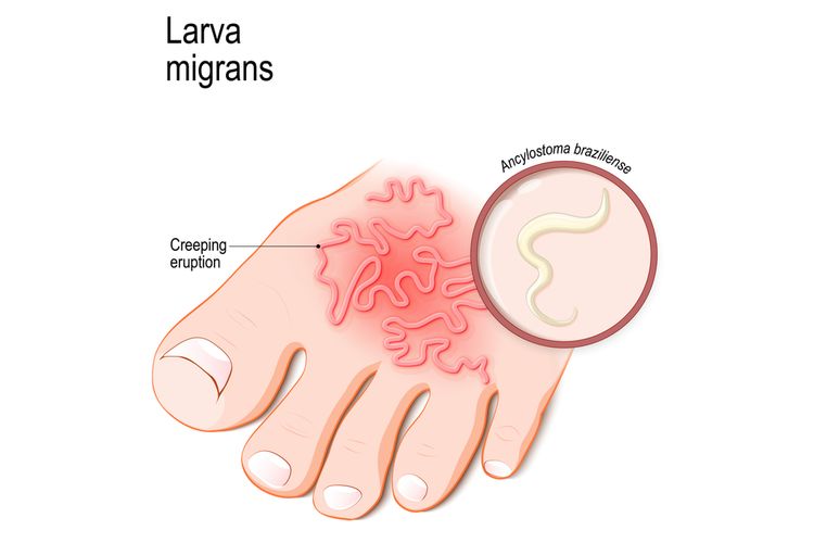 Ilustrasi infeksi larva cacing tambang