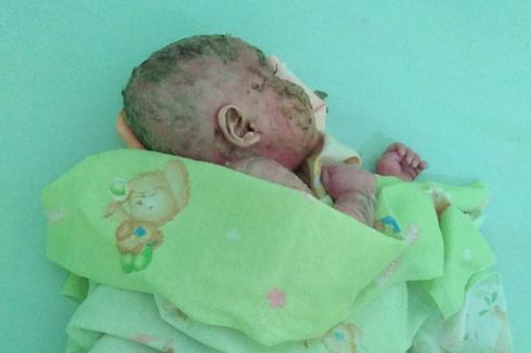 5 Fakta Bayi Mizyan Berkulit Mirip Plastik, Lahir Normal hingga Tinggal di Kampung Transmigran