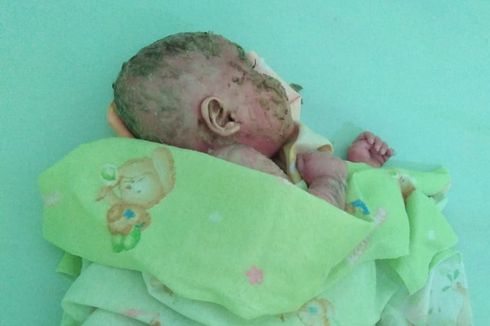 Derita Bayi Mizyan, Kulitnya seperti Plastik, Selalu Menangis Saat Mengelupas