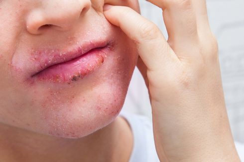 6 Penyebab Bibir Kering dan Gatal yang Perlu Diketahui