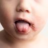 5 Gejala Herpes pada Bayi, Orangtua Perlu Waspada
