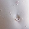 Molluscum Contagiosum