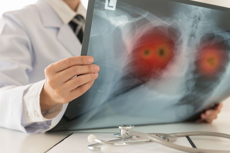 Ilustrasi kanker paru. Infeksi Covid-19 bisa memperparah kondisi pasien kanker paru. 
