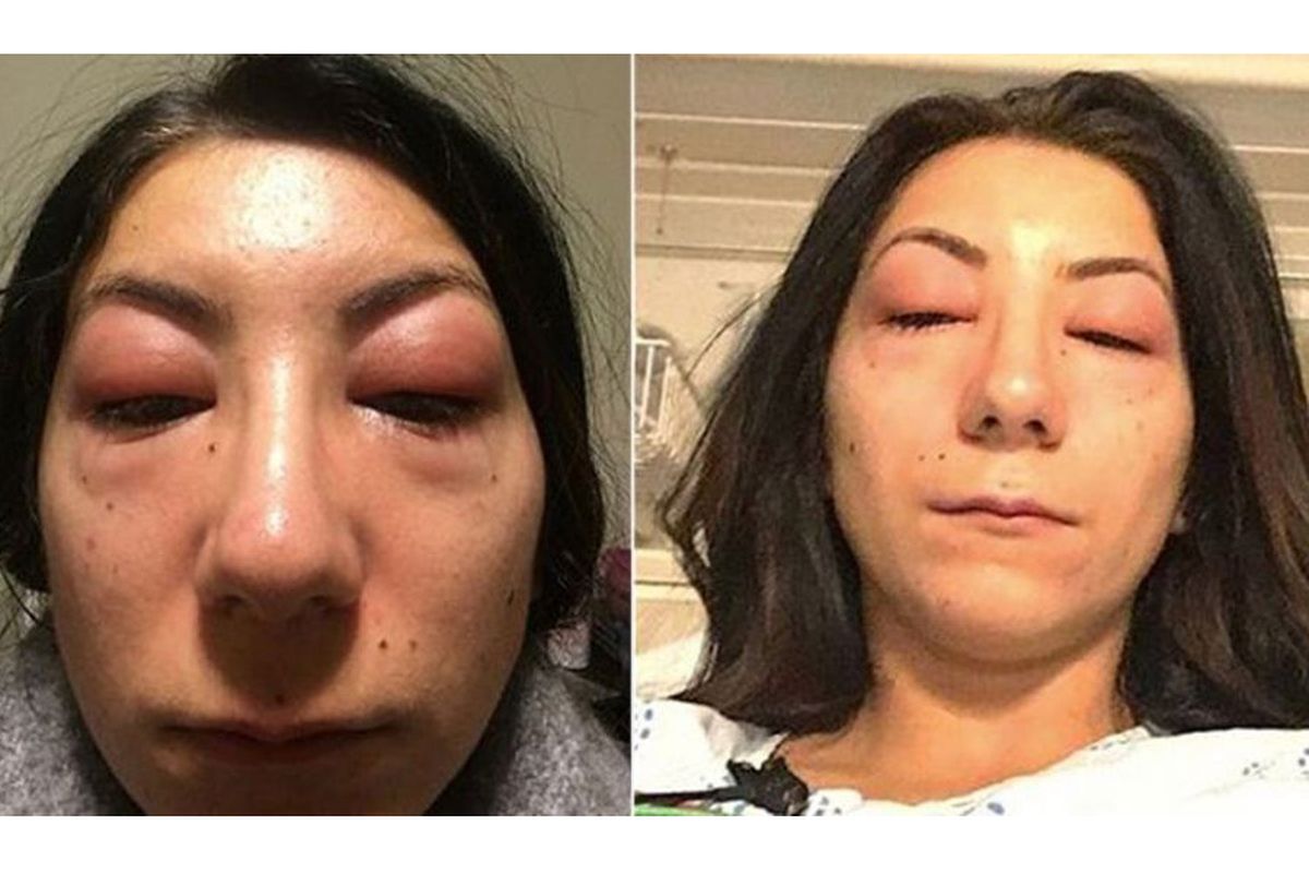 Isabelle Kun, seorang perempuan asal Kanada membagikan foto matanya yang bengkak setelah pemasangan bulu mata sambung ke akun media sosial Facebook.  