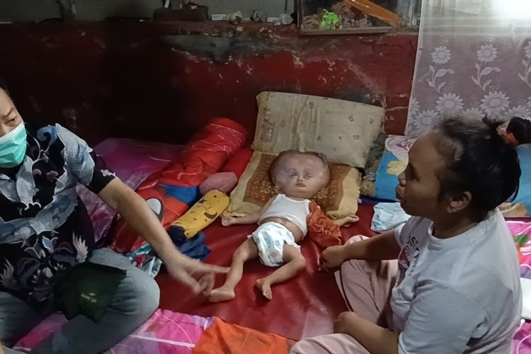Bayi Pengidap Hidrosefalus di Subang Kesulitan Berobat, Tak Punya Ongkos ke RSHS