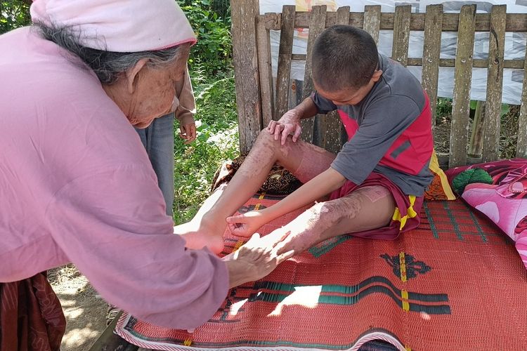 Alami Luka Bakar dan Tak Bisa Berjalan, Kondisi Santri yang Diduga Dibakar Temannya di Lombok