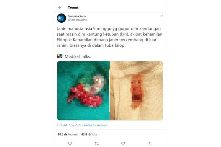 Tangkapan layar soal janin yang gugur karena kehamilan ektopik