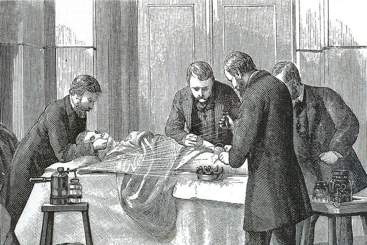 Joseph Lister menyemprotkan cairan fenol di atas luka saat para dokter sedang melakukan operasi. Penemuan antiseptik ini telah menyelamatkan jutaan nyawa di dunia.