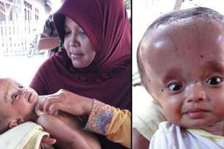 Misbah dan bayinya, Wildan, yang menderita penyakit hydrocephalus di Bima. Orangtua Wildan tidak mampu membawa anaknya berobat ke rumah sakit rujukan, yakni RSUD Sanglah, Denpasar.