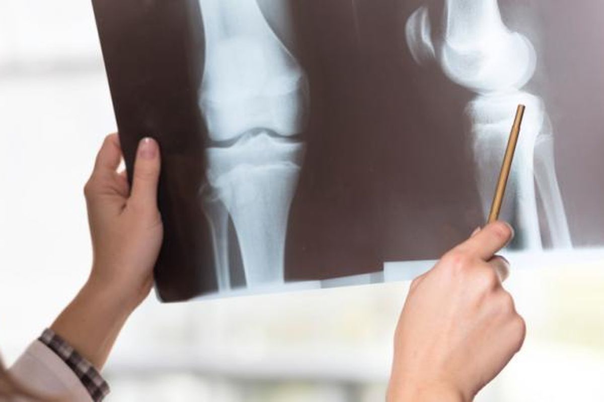 Ilustrasi osteoporosis, kualitas tulang menurun pada lansia.