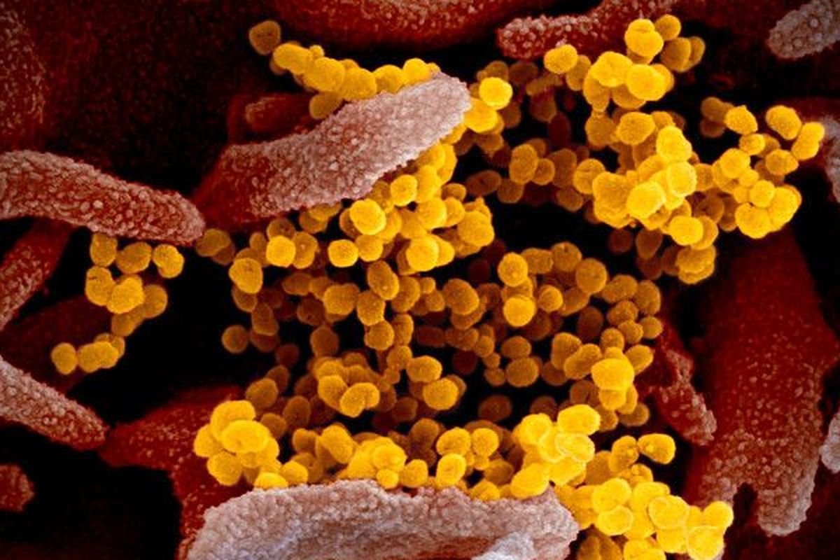 Gambar mikroskop elektron pemindai ini menunjukkan virus corona Wuhan atau Covid-19 (kuning) di antara sel manusia (merah). Sampel virus diambil dari seorang pasien AS yang terinfeksi. Para ahli menambahkan gambar agar lebih tampak.