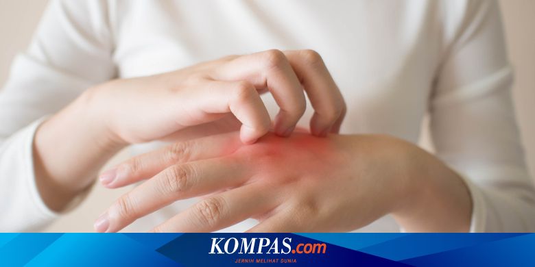 Punya Penyakit Kulit Eksim Ini Cara Mudah Merawatnya Di Rumah Halaman All Kompas Com