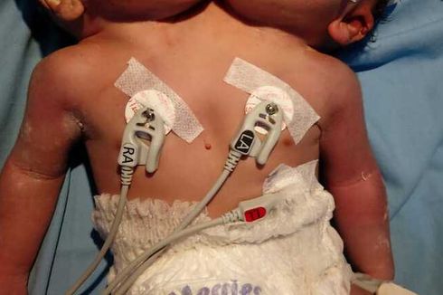 Dirut RSUP M Djamil Padang: Organ Tubuh Pasien Bayi Kembar Siam Tidak Lengkap