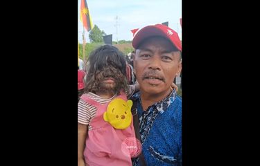 Kisah Bocah 2 Tahun asal Malaysia yang Dijuluki "Manusia Serigala ...