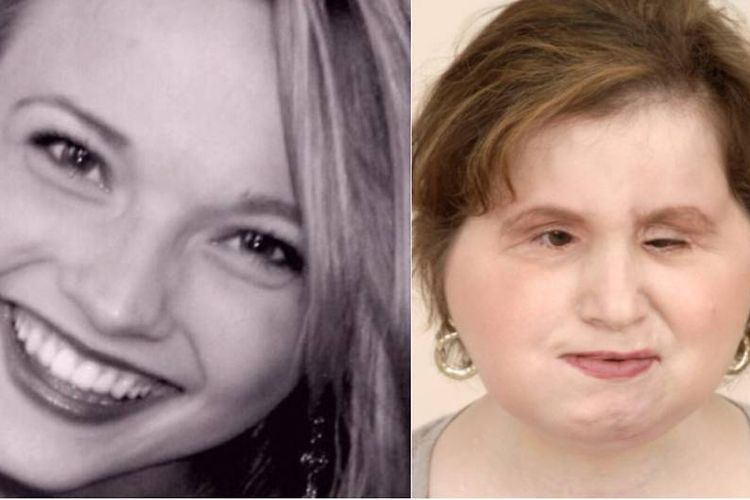 Katie Stubblefield, perempuan termuda yang mendapat transplantasi wajah