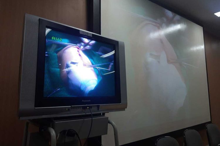 Layar monitor yang menunjukkan proses operasi pemisahan bayi kembar siam Aqila dan Azila di RSU dr Soetomo, Rabu (14/8/2019)