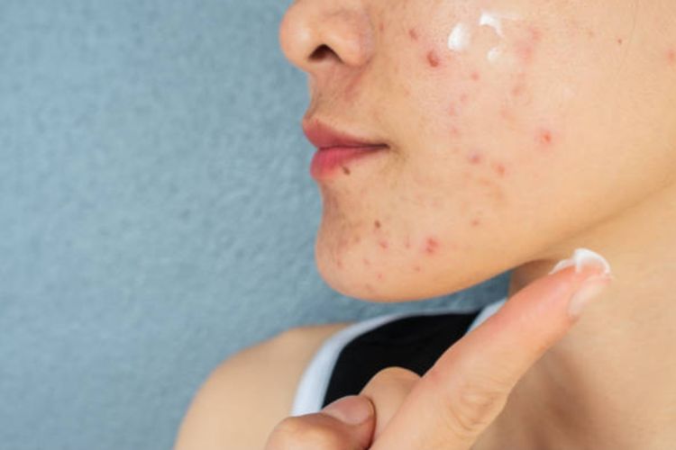 4 Cara Menghilangkan Jerawat Besar, Rajin Pakai Obat Jerawat