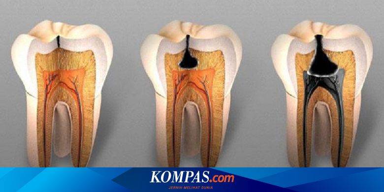 Jangan Sepelekan Lubang Gigi Akibatnya Lebih Besar Dari Dugaan Halaman All Kompas Com