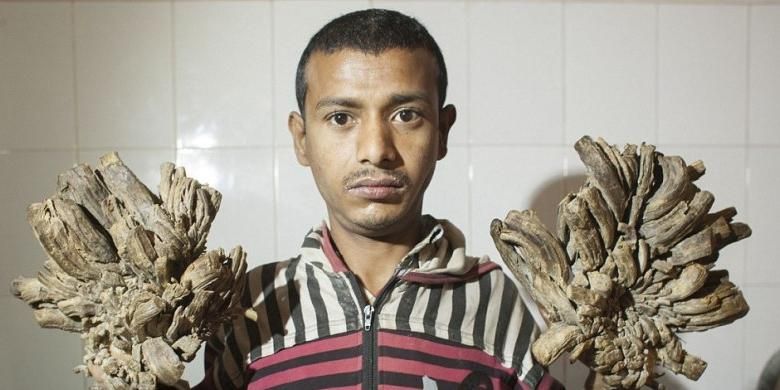 Pria asal Banglades ini juga mengalami kondisi langka seperti Dede Koswara asal Bandung, Indonesia yang dijuluki 'Manusia Akar'