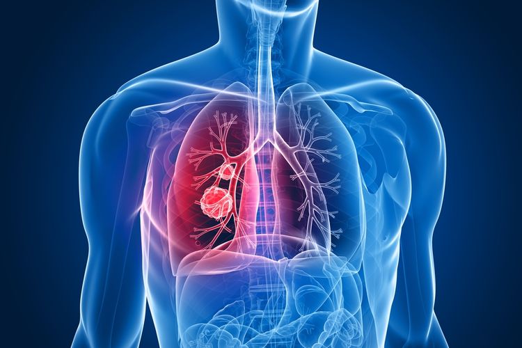Kanker paru-paru dapat menyebabkan sejumlah komplikasi serius, meliputi dispnea, hemoptisis, kompresi sumsum tulang belakang, dan pneumonia. 