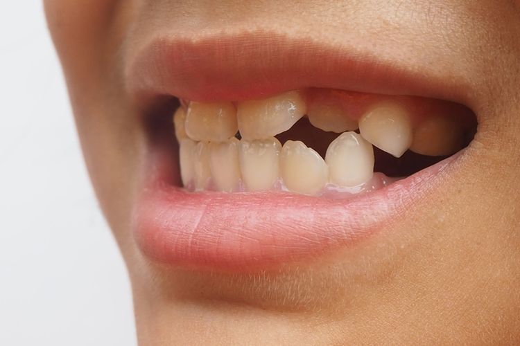 Mengetahui apakah gigi tidak rapi bisa diperbaiki atau tidak sangatlah penting untk mendapatkan perawatan yang tepat.